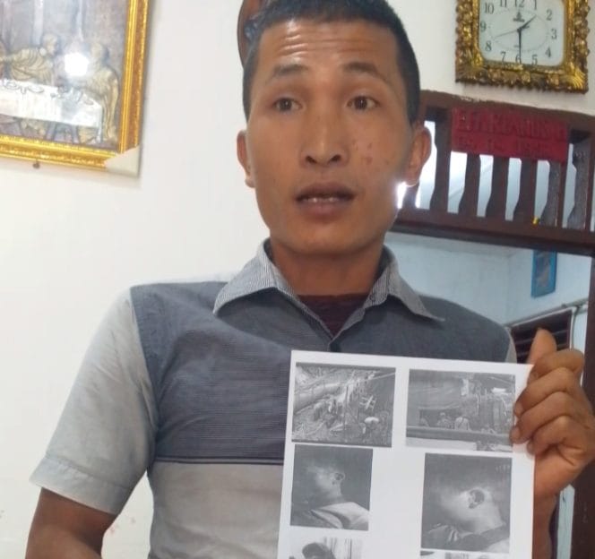 Keterangan Foto : Lesmanan Halawa, korban penganiayaan yang terjadi pada tahun 2022 dan diduga dilakukan oleh seorang bos tambang emas ilegal di Desa Tangga Bosi Bukit Siayo, Kecamatan Siabu, Kabupaten Mandailing Natal, Sumatera Utara.